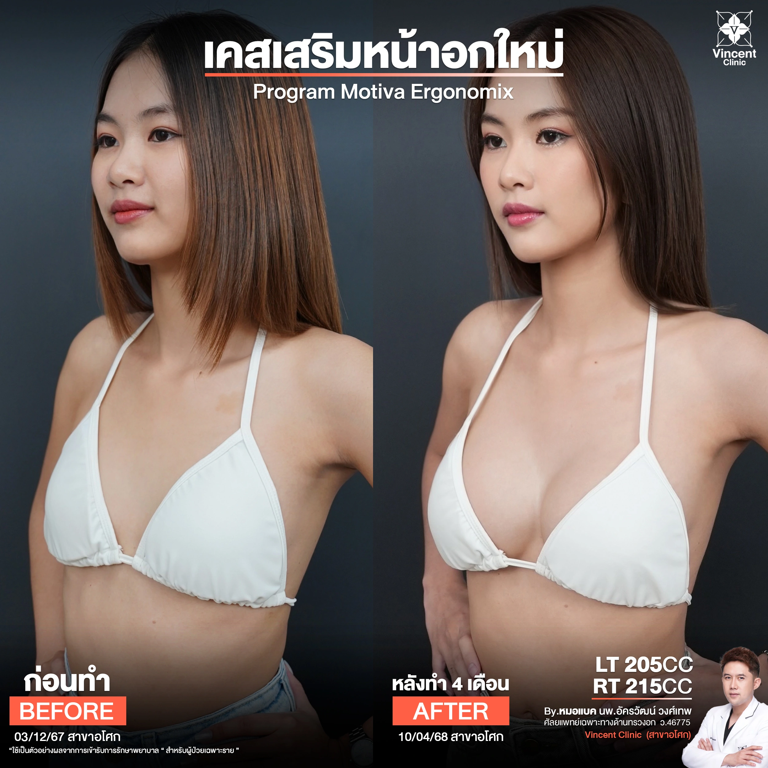 รีวิวเสริมหน้าอก 