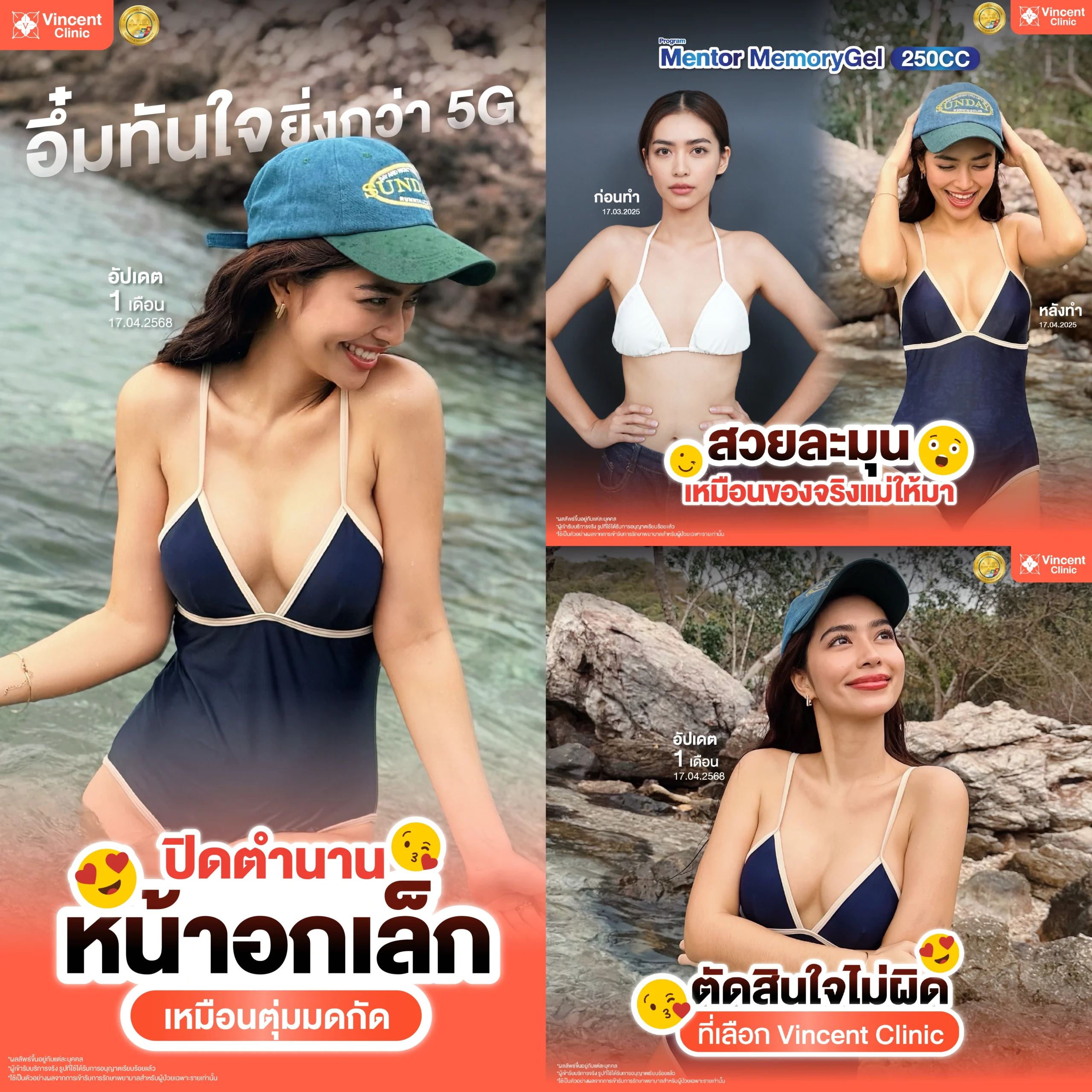 รีวิวเสริมหน้าอกทรงหยดน้ำ